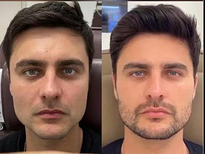 Harmonização facial se consolida como queridinha no mercado da vaidade masculina