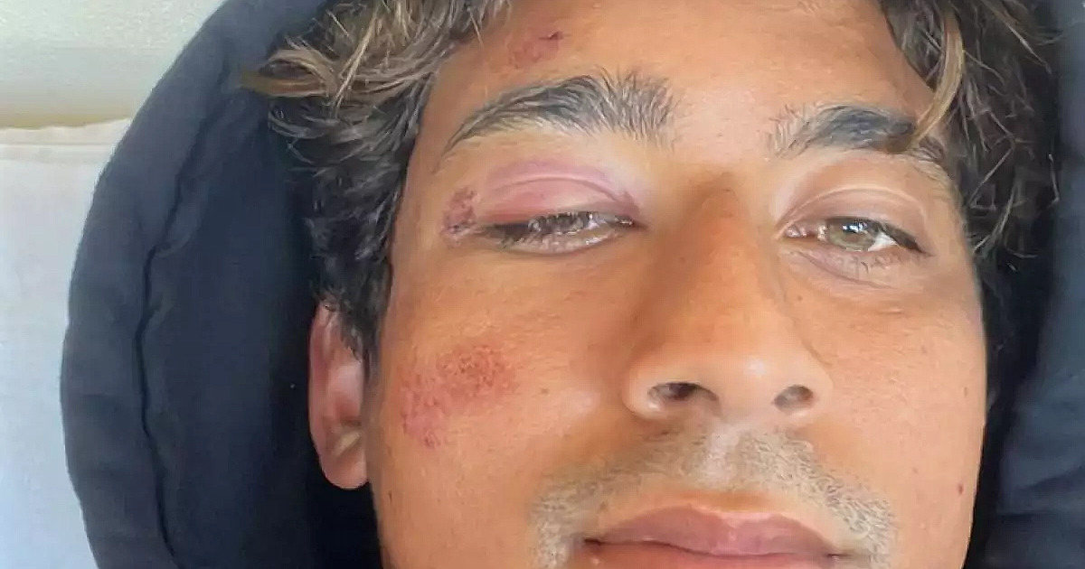 Surfista Samuel Pupo sofre acidente no Havaí