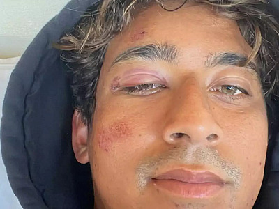 Surfista Samuel Pupo sofre acidente no Havaí